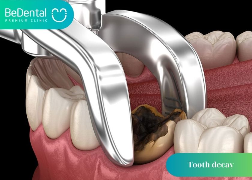 Is tooth decay on the inside or outside dangerous? How to effectively prevent side tooth decay? What causes lateral tooth decay?