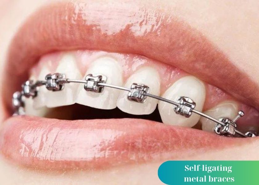 Advantages of self-ligating metal braces