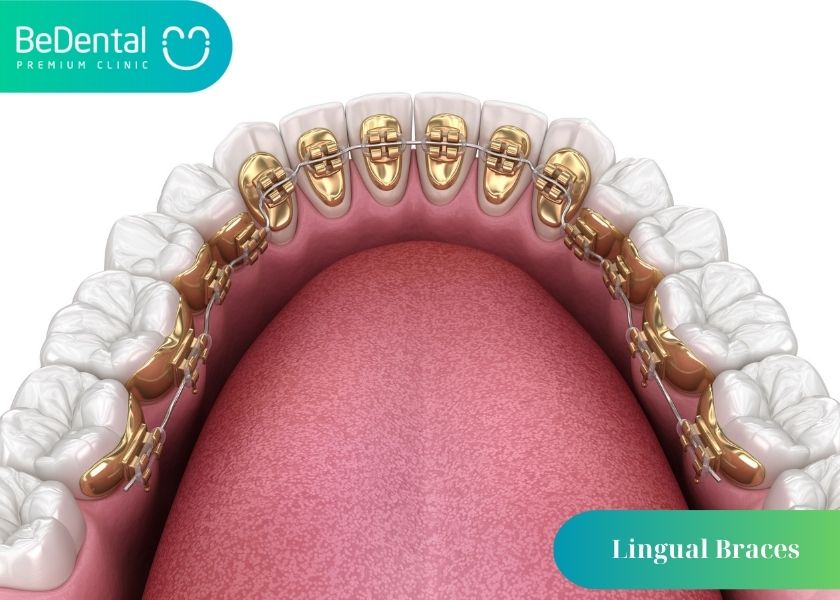 What is lingual brace?