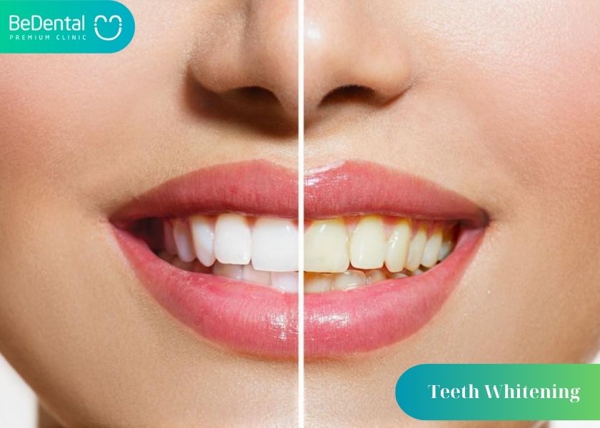 What is Teeth Whitening?