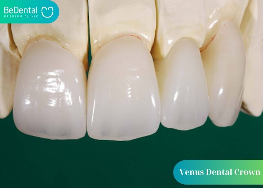 Venus teeth - Venus porcelain dental crowns from Germany