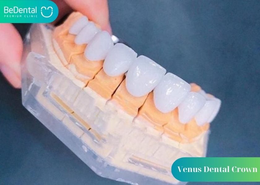 Advantages of Venus dental crowns