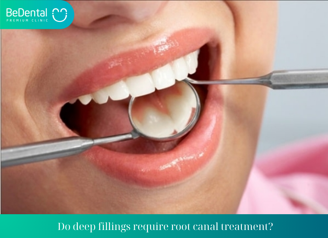 Do deep fillings require root canal treatment