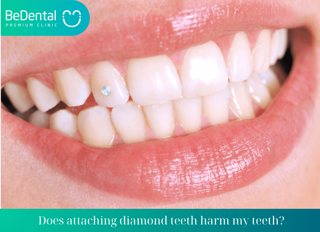 Does attaching diamond teeth harm my teeth