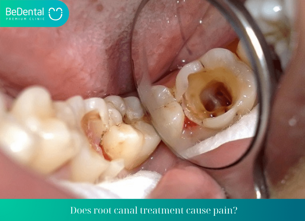 Does root canal treatment cause pain