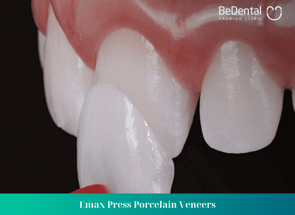 Emax Press Porcelain Veneers