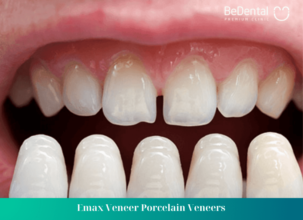 Emax Veneer Porcelain Veneers