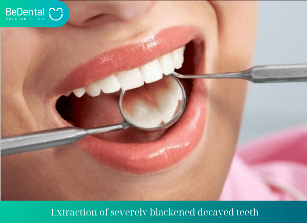 Extraction of severely blackened decayed teeth