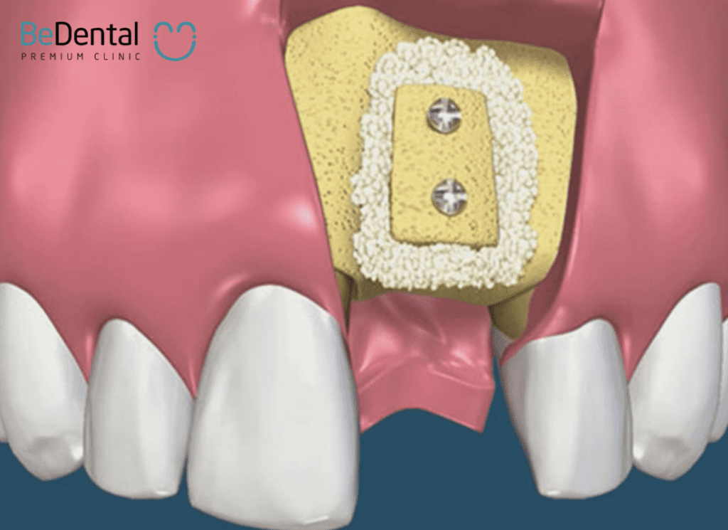 How much does jawbone grafting cost