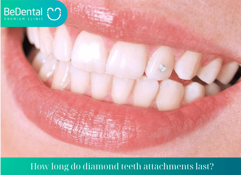 How long do diamond teeth attachments last