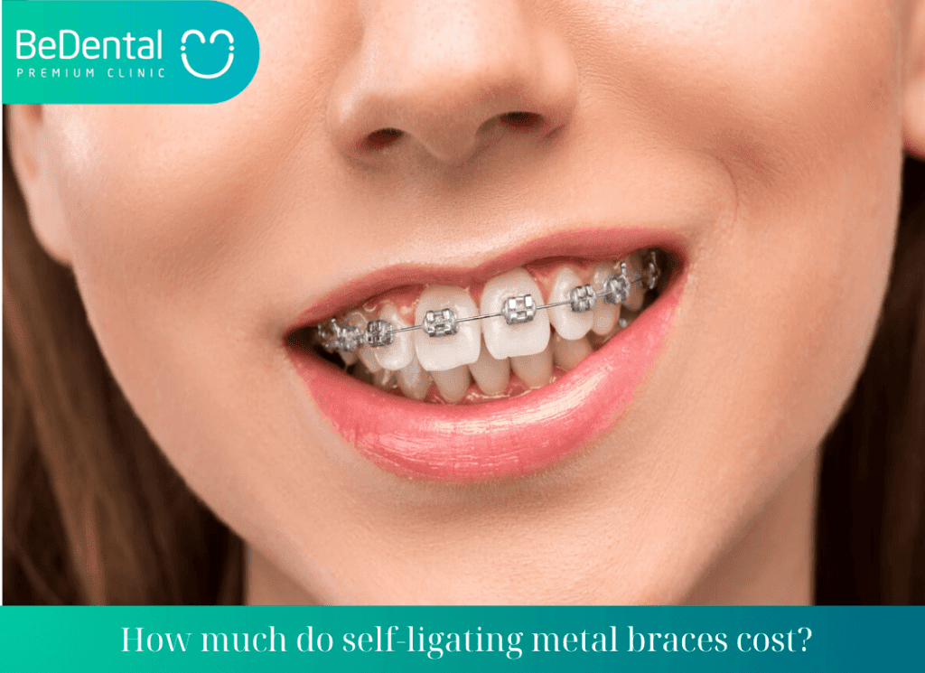 How much do self ligating metal braces cost