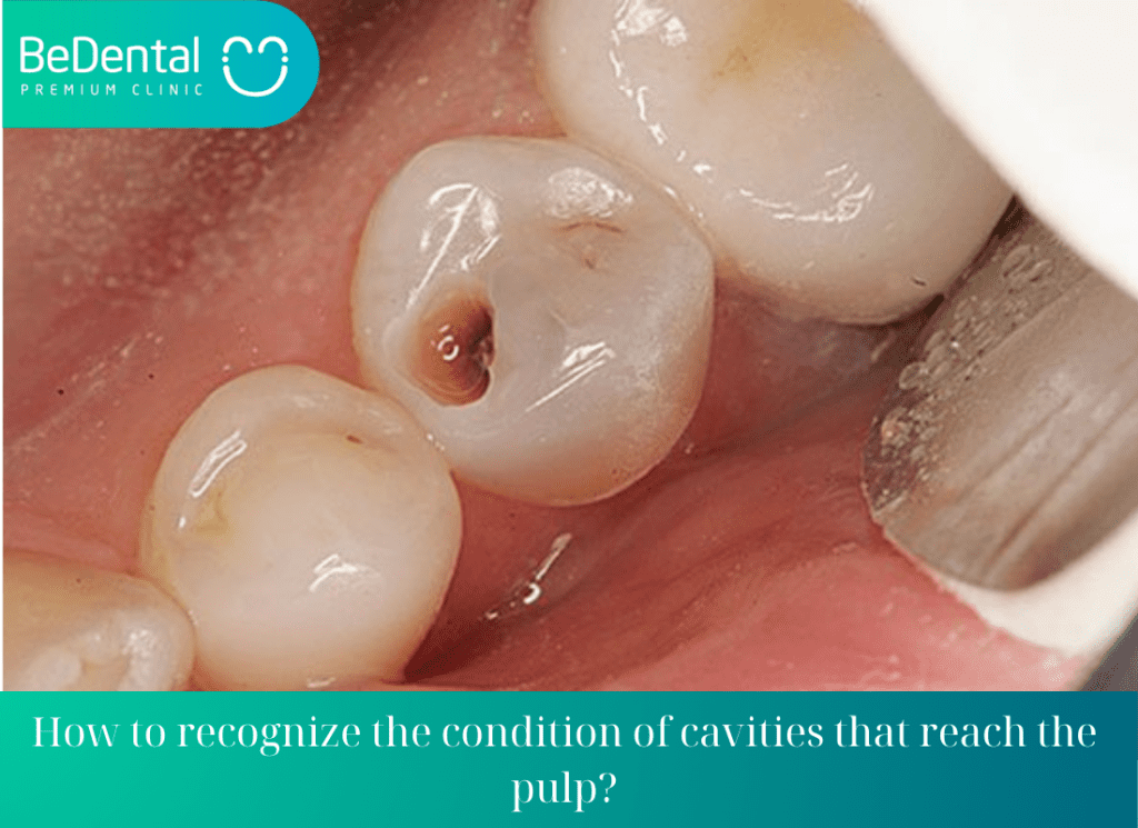 How to recognize the condition of cavities that reach the pulp