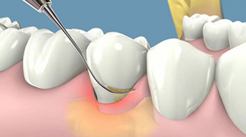 Is dental scaling covered by insurance