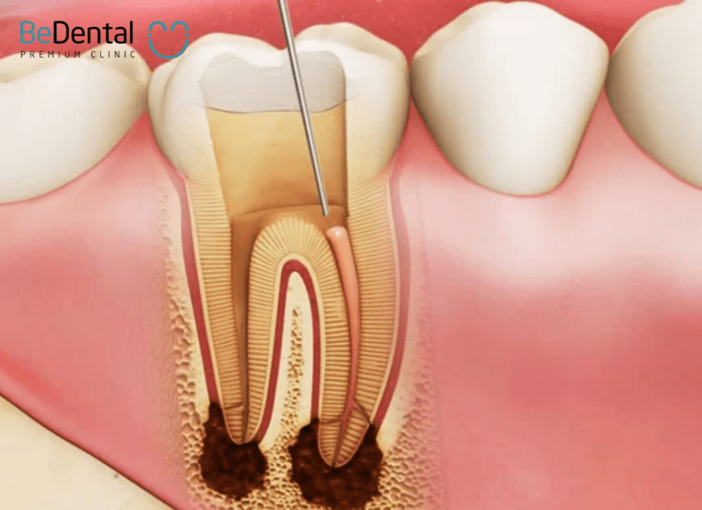 Root Canal treatment