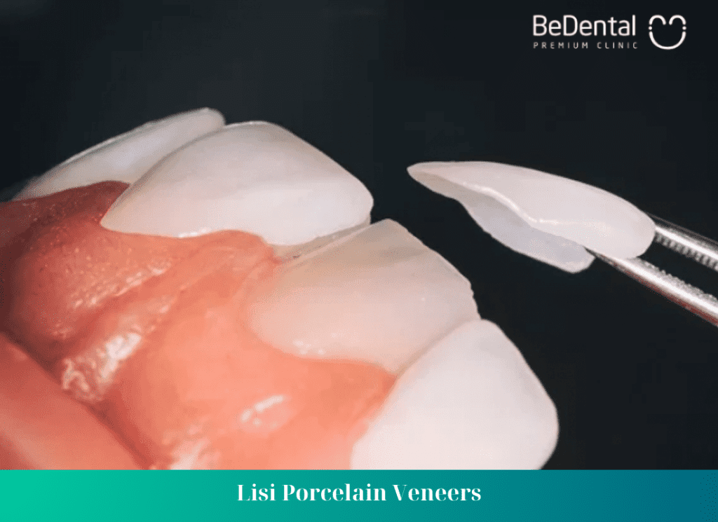 Lisi Porcelain Veneers