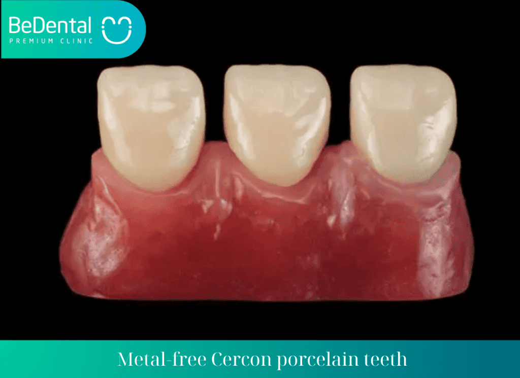 Metal free Cercon porcelain teeth