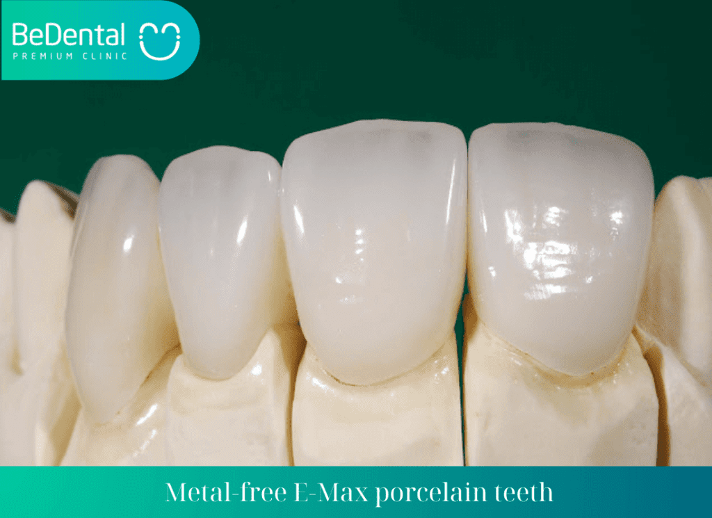 Metal free E Max porcelain teeth