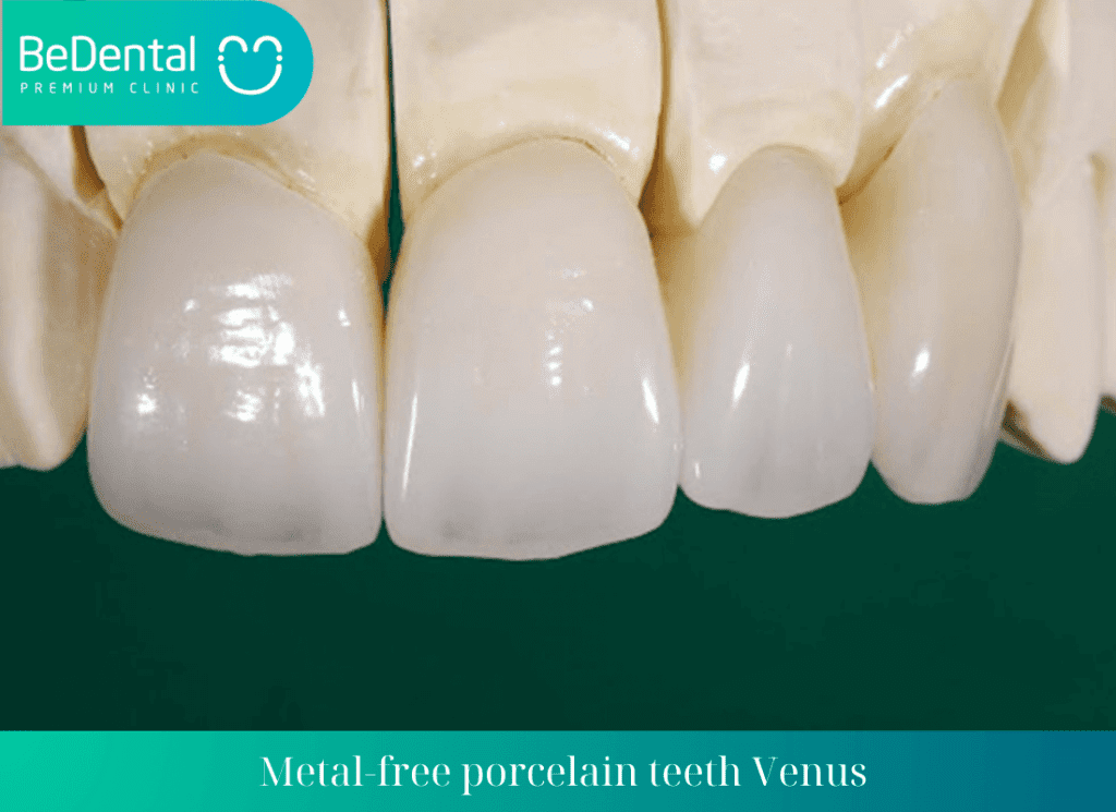 Metal free porcelain teeth Venus