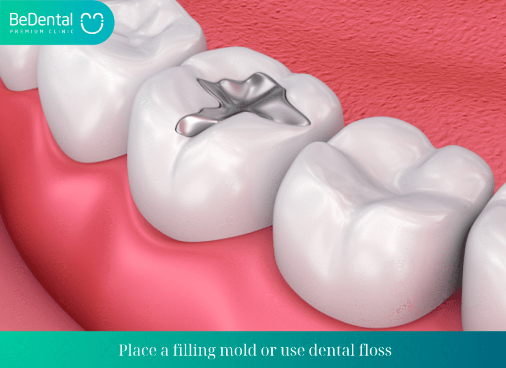 Place a filling mold or use dental floss