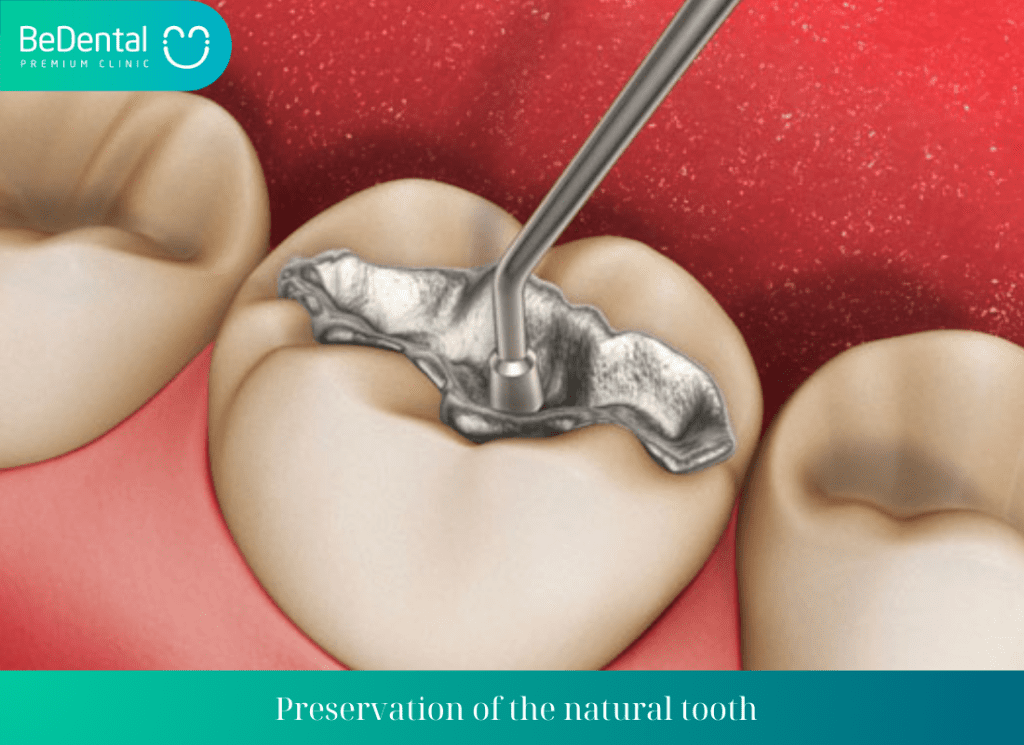 Preservation of the natural tooth