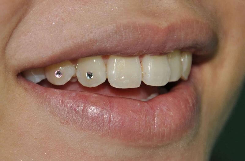 How to attach tooth stones at home?