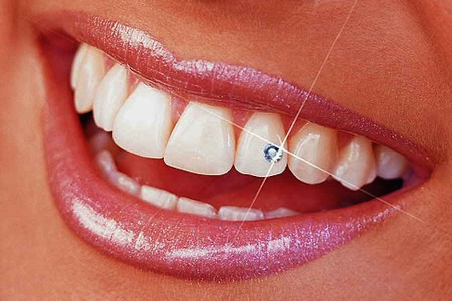 Diamond-Encrusted Teeth