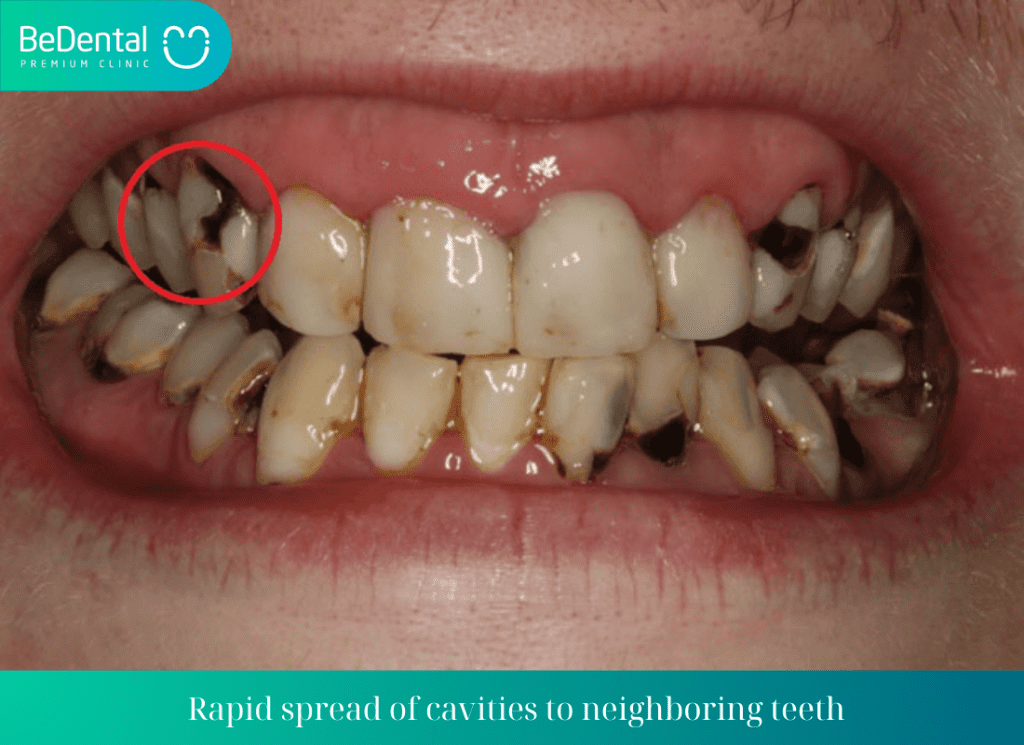 Rapid spread of cavities to neighboring teeth