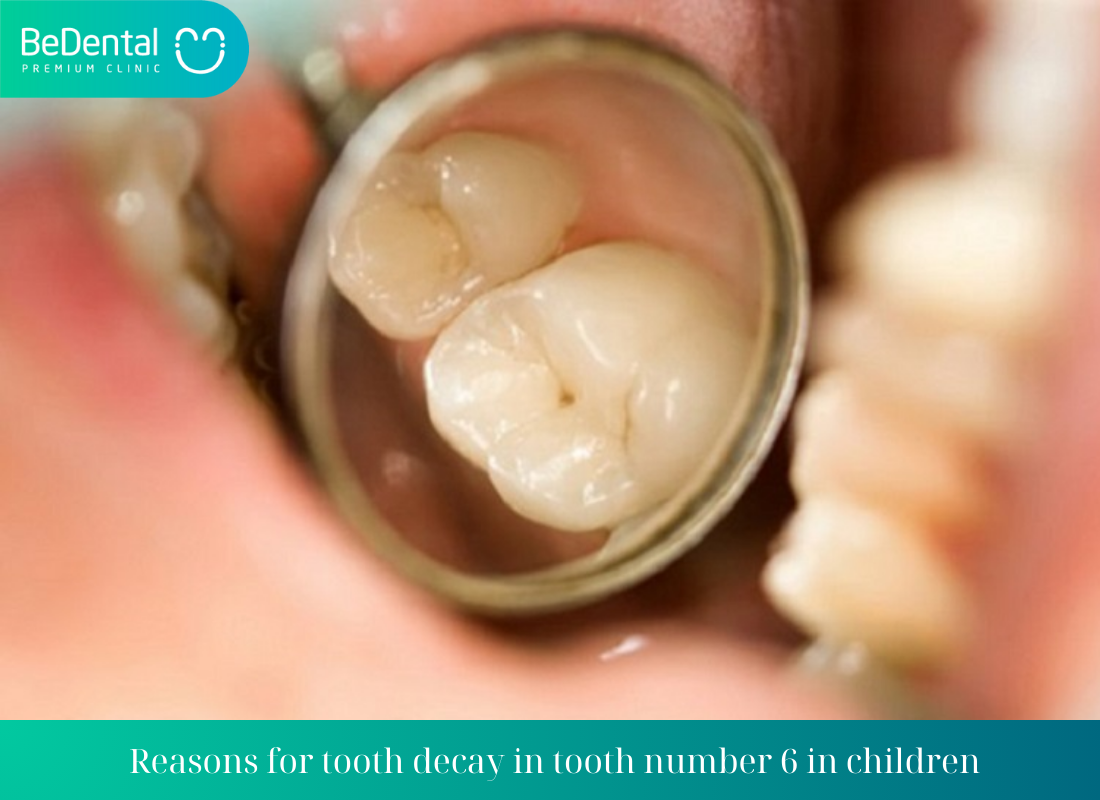 Reasons for tooth decay in tooth number 6 in children