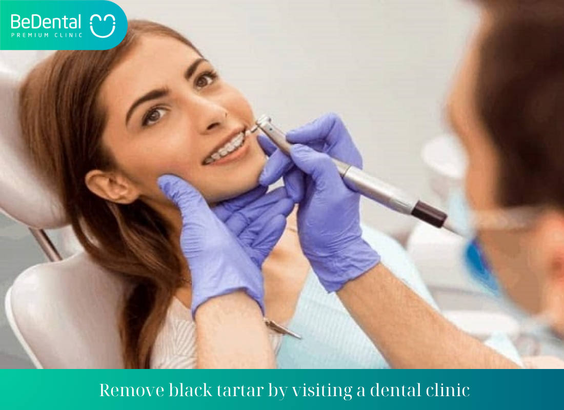 Remove black tartar by visiting a dental clinic