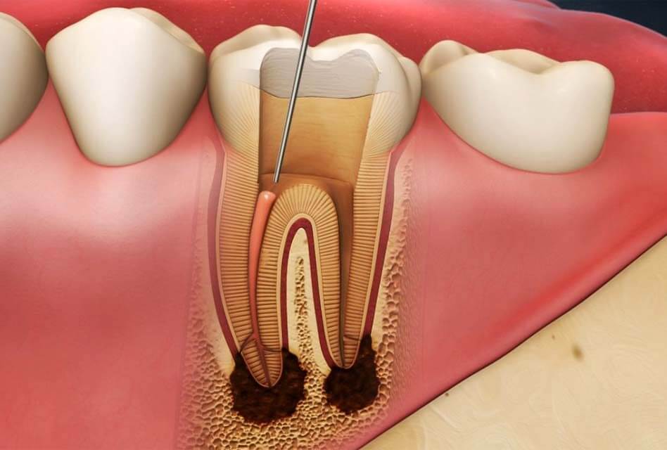 Root Canal 1