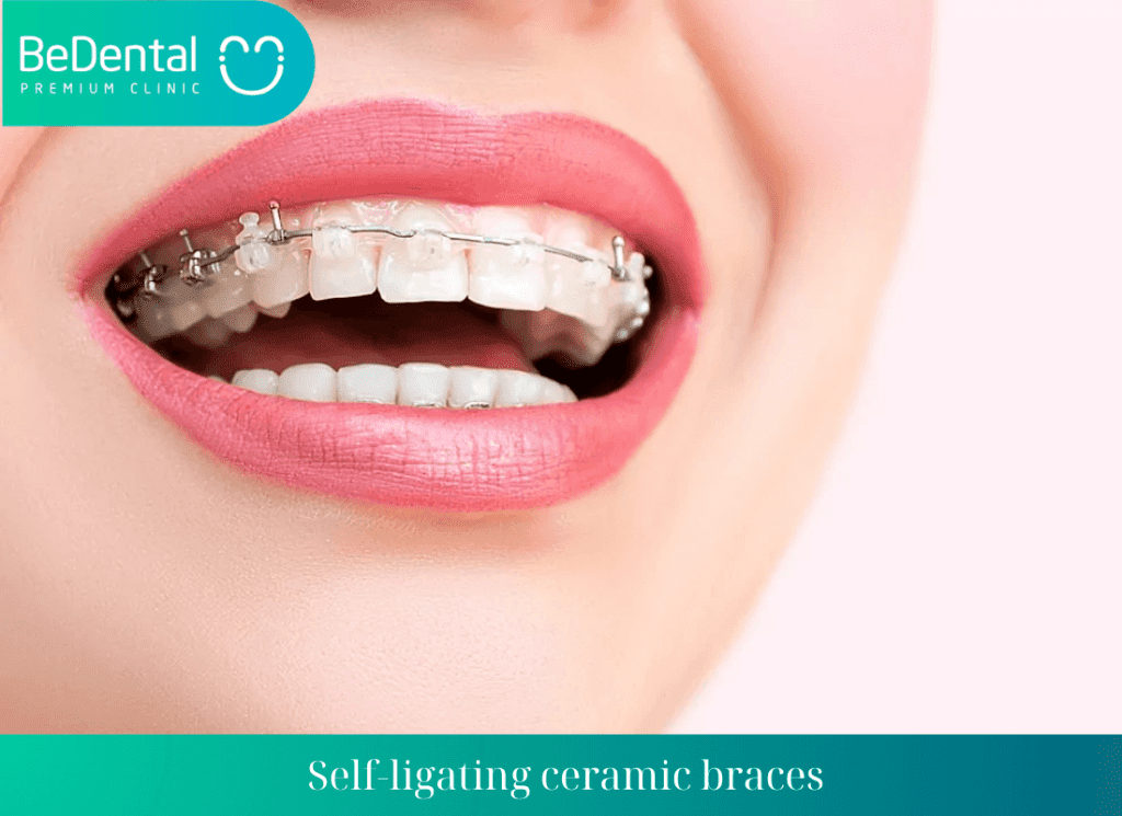 Self ligating ceramic braces