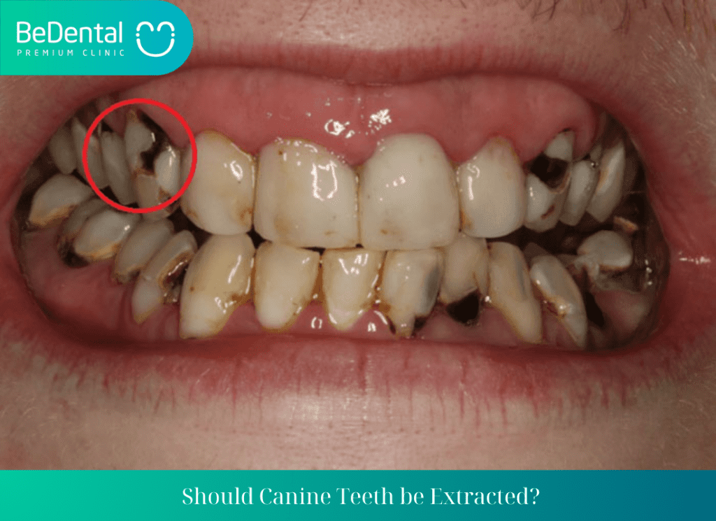 Should Canine Teeth be Extracted