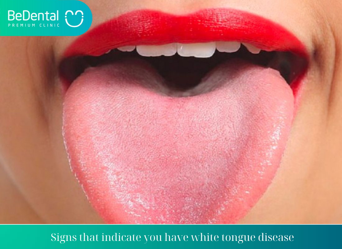 What is white tongue disease