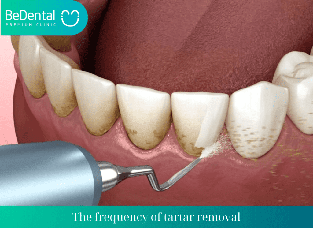 The frequency of tartar removal