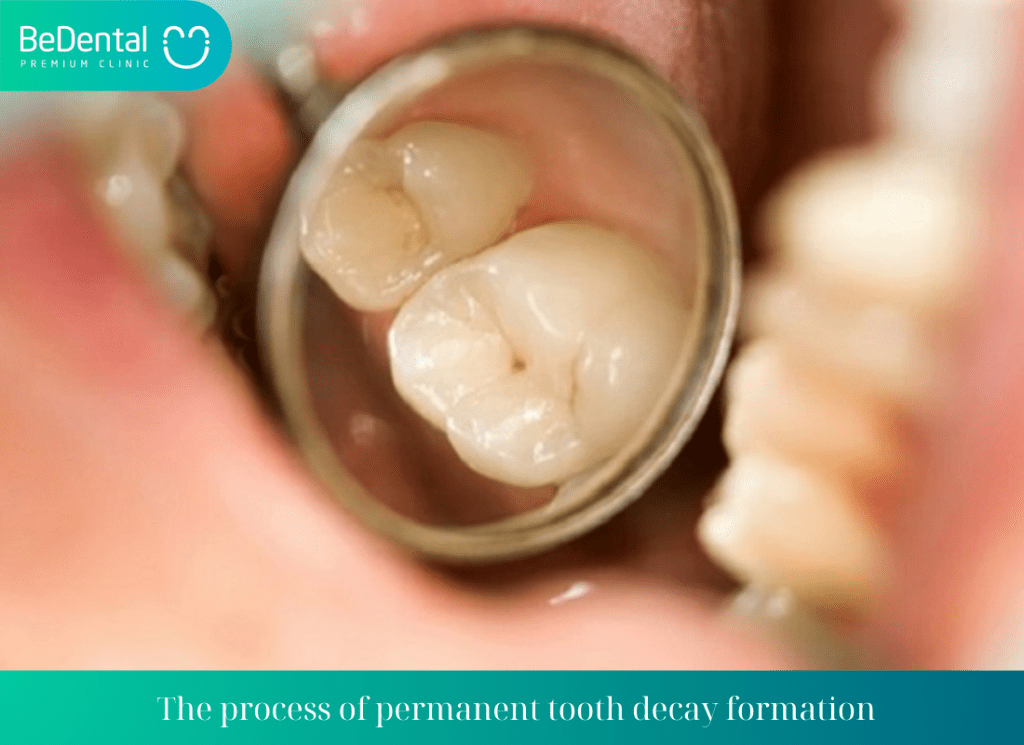 The process of permanent tooth decay formation