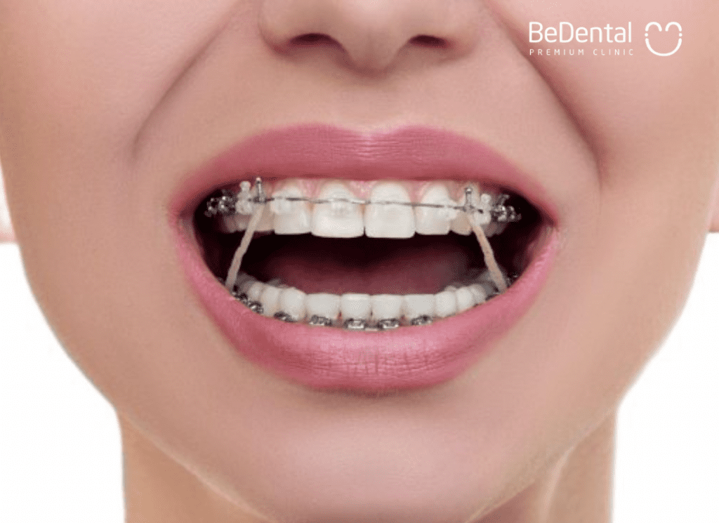 orthodontic elastics