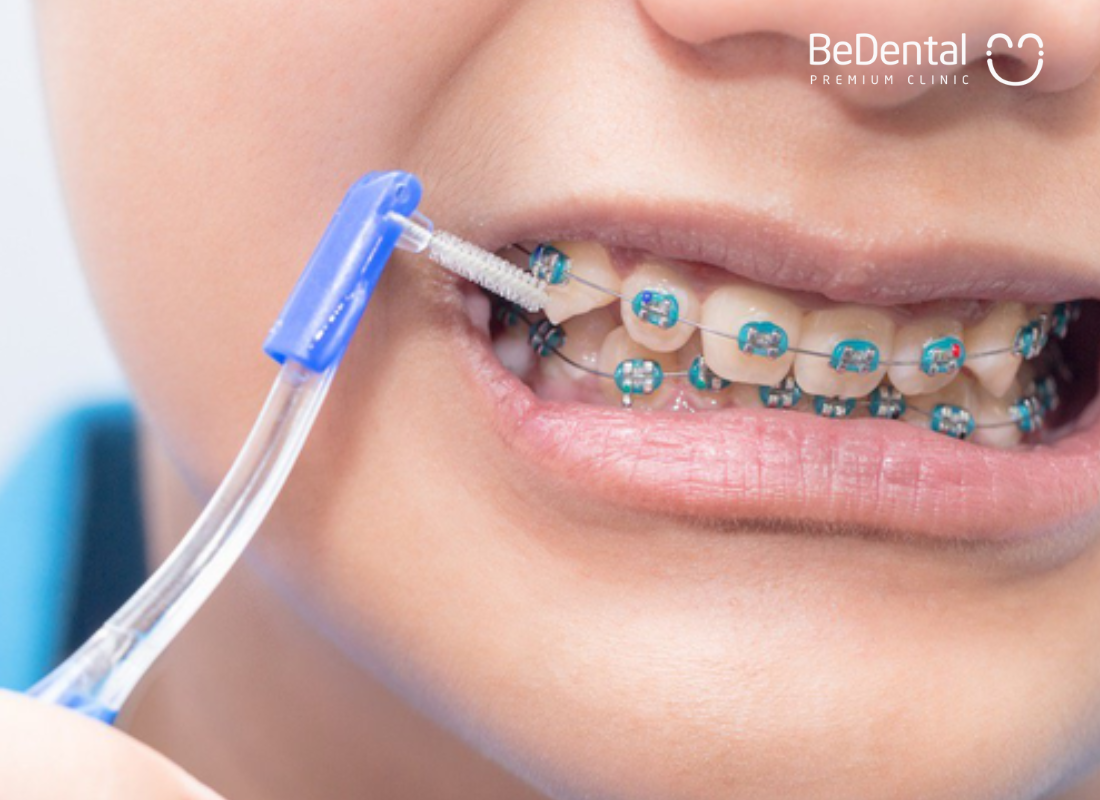 What is teeth tightening with braces? 7 effective tips to reduce pain