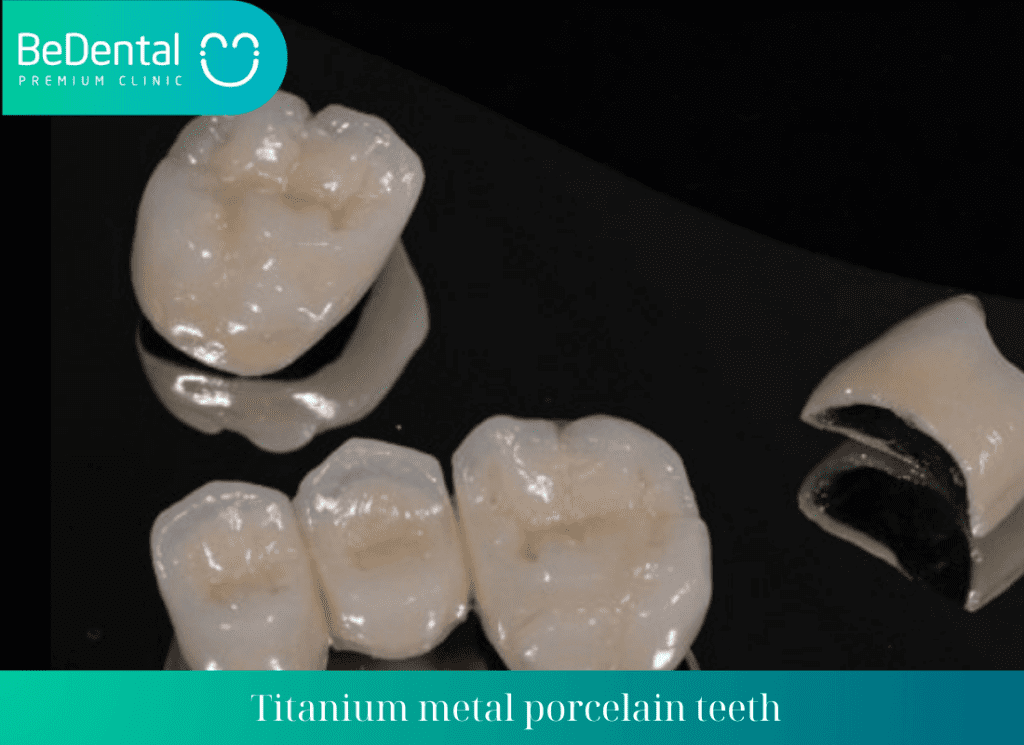 Titanium metal porcelain teeth