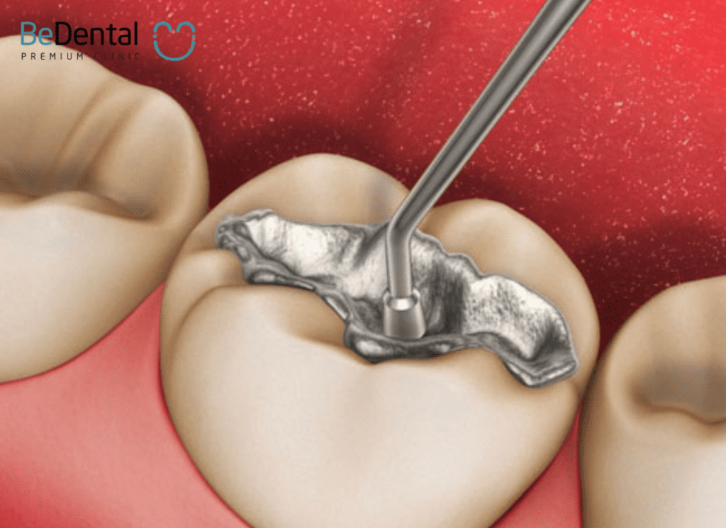 deep tooth filling process 