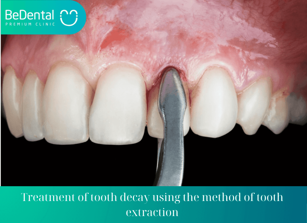 Treatment of tooth decay using the method of tooth extraction