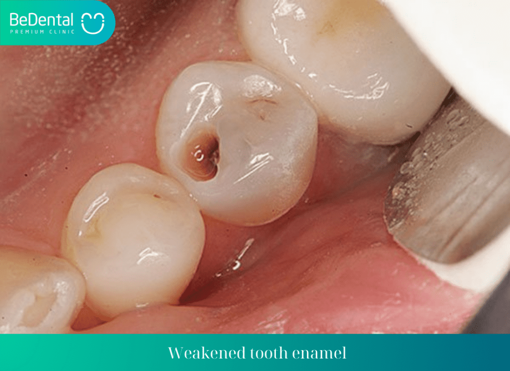 Weakened tooth enamel