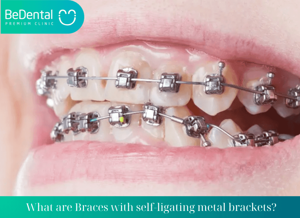 What are Braces with self-ligating metal brackets