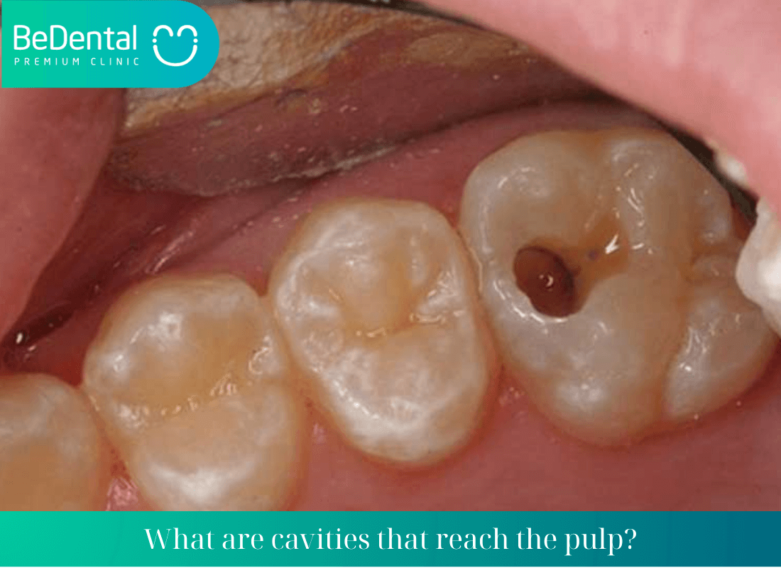 What are cavities that reach the pulp