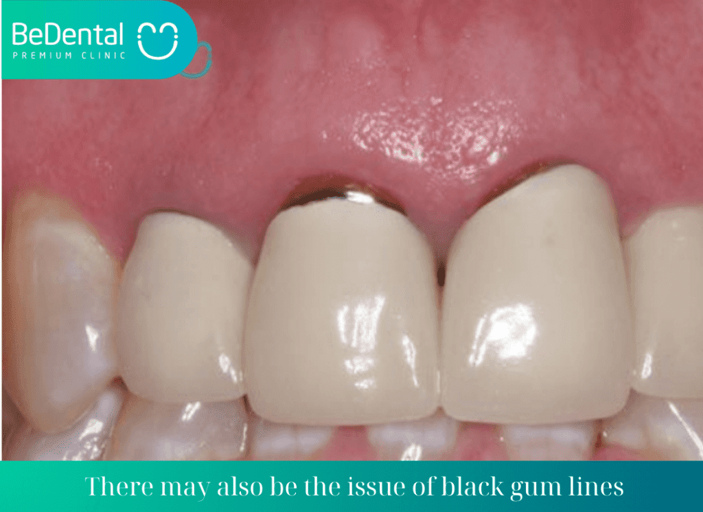 there may also be the issue of black gum lines