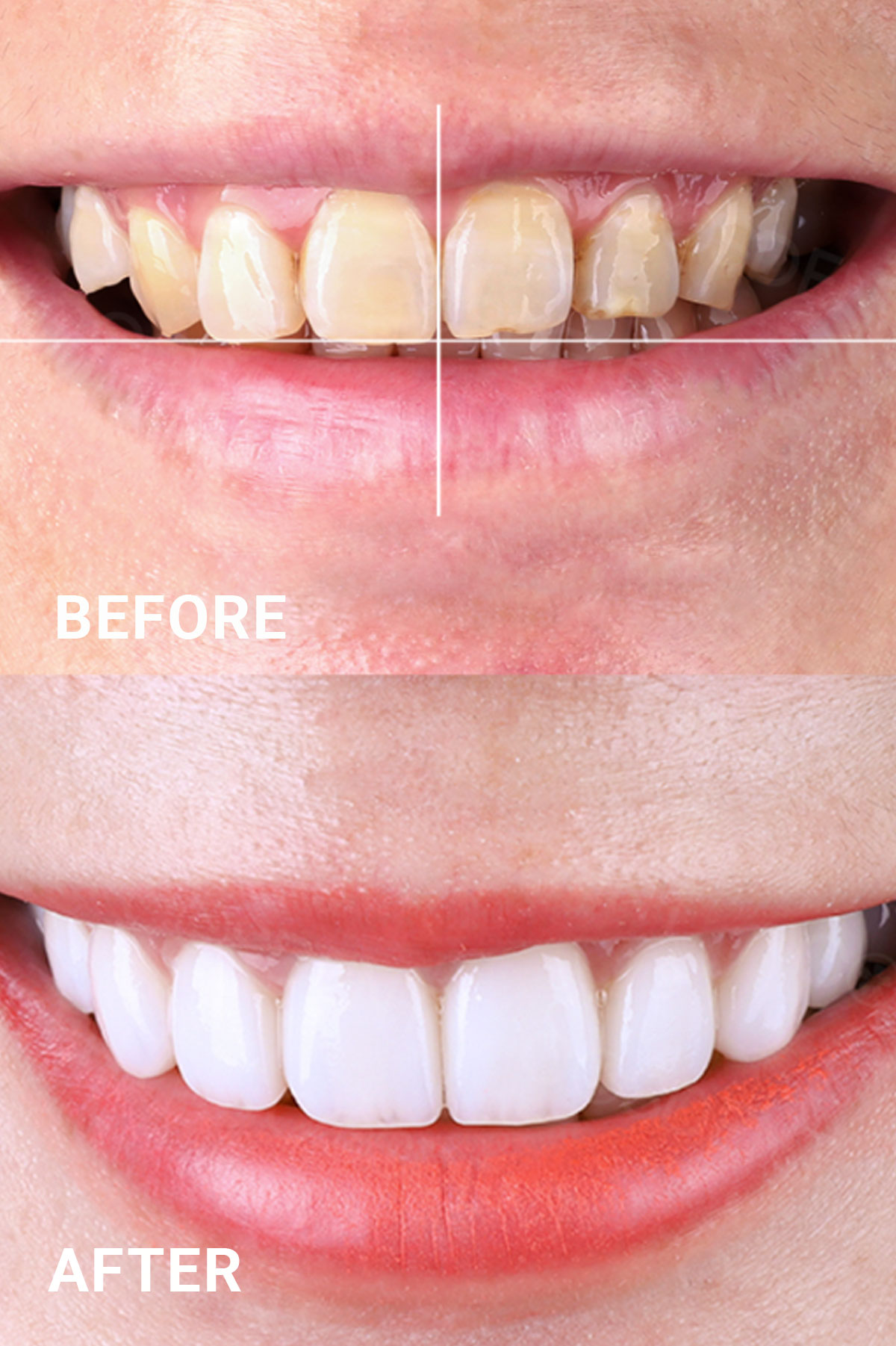 Hiệu quả thực tế của công nghệ tẩy trắng răng WhiteMax