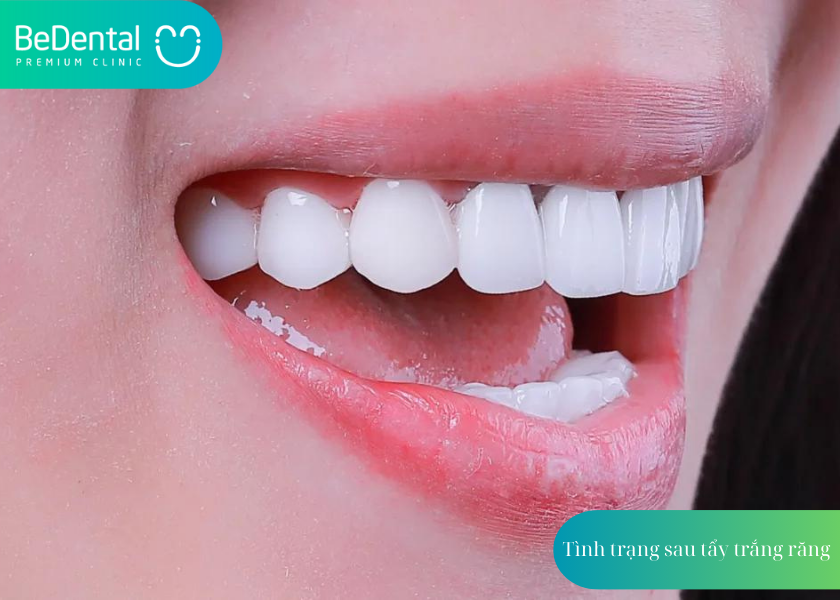 Tình trạng của răng sau khi tẩy trắng