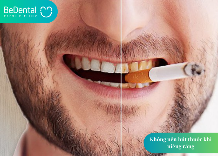 Tác hại của hút thuốc đối với răng