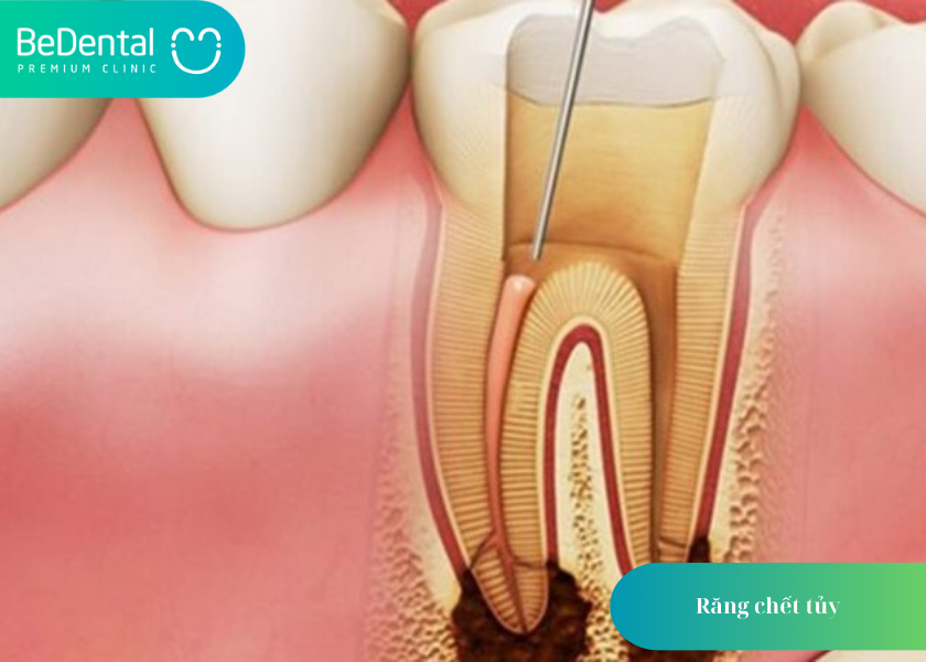 Niềng răng sai cách dẫn đến chết tuỷ răng