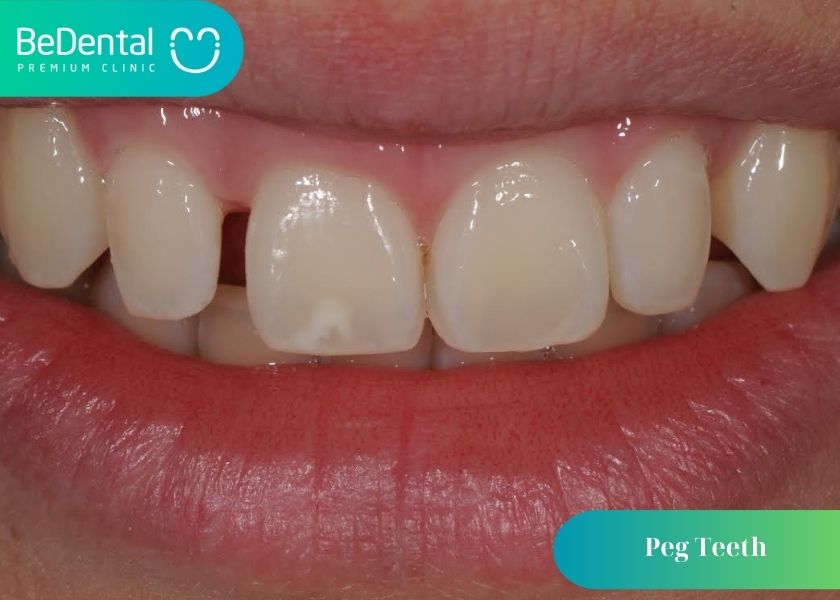 What are peg teeth? What kind of person is a person with peg teeth? How to fix peg teeth? Where to fix peg teeth in Hanoi?