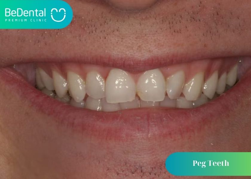 What are peg teeth? What kind of person is a person with peg teeth? How to fix peg teeth?